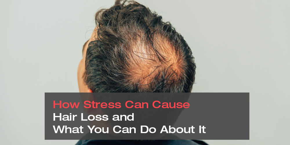 How Stress Can Cause Hair Loss and What You Can Do About It