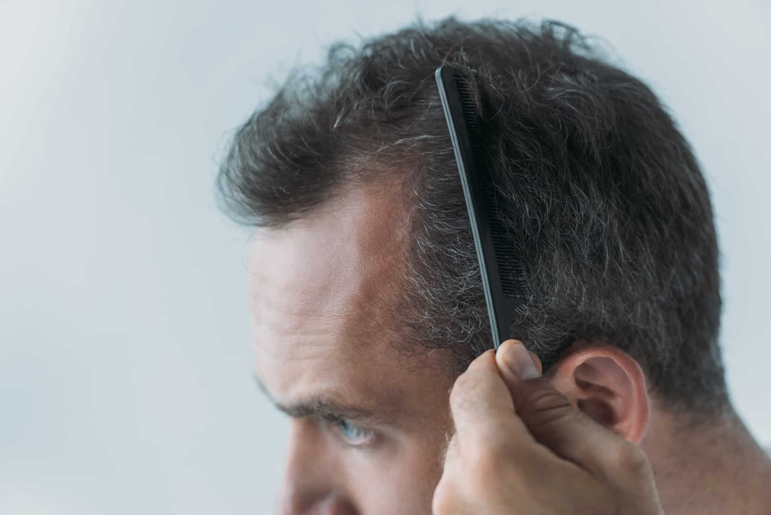 Finasteride vs. Minoxidil: Which Is Better for Hair Loss?