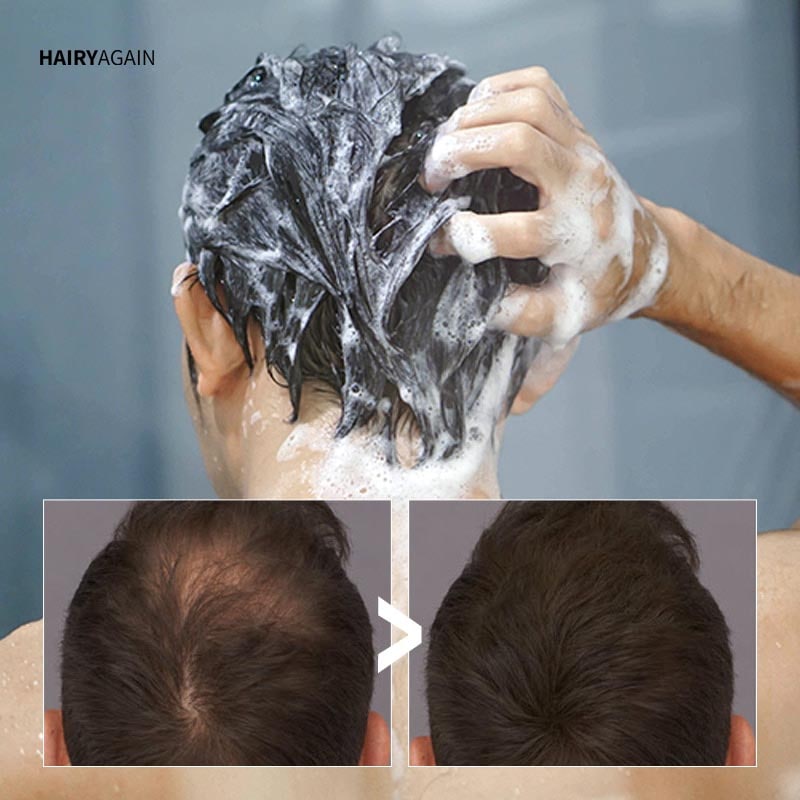 Anti-Thinning Shampoo - HairyAgain©