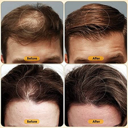 5% Minoxidil Extreme Hair Growth